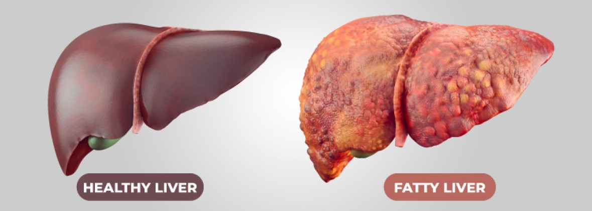 ফ্যাটি লিভার: এক বেখেয়ালি মারাত্মক ব্যাধির নাম